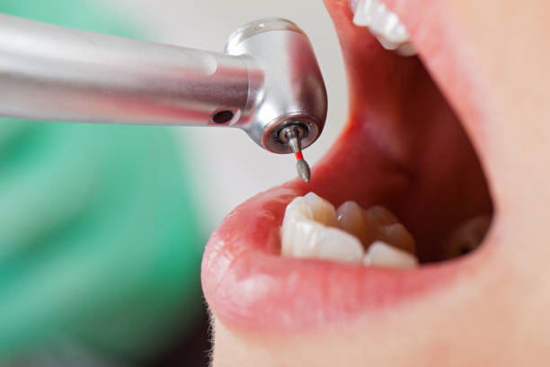Best Emergency Wisdom Tooth Extraction in Snyder, TX